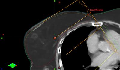 Dosimetric Impact of Inter-Fraction Variability in the Treatment of Breast Cancer: Towards New Criteria to Evaluate the Appropriateness of Online Adaptive Radiotherapy